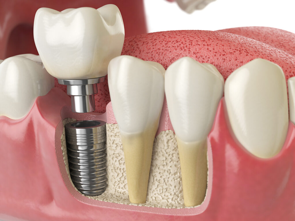 最新消息 1 implant img2